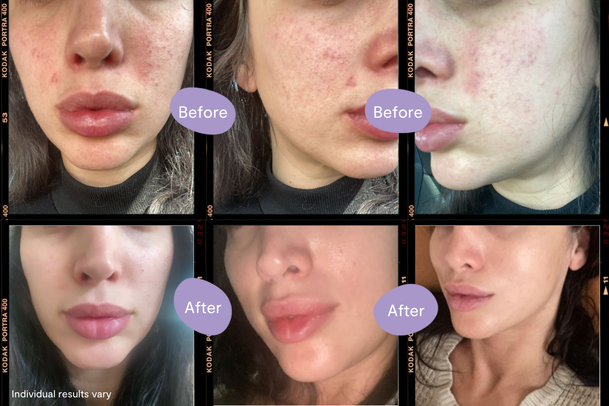 Before & After: Chrissyās Skincare Journey